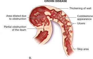 Crohn disease with thickened wall and ulcers