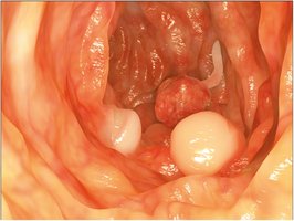 Colonic polyps