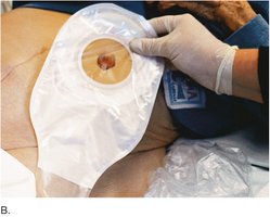 Colostomy bag attached to stoma