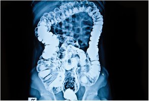 Barium enema x-ray of the colon