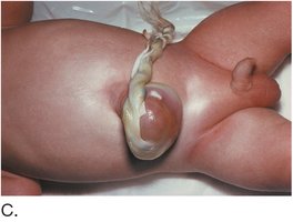 Omphalocele in a newborn