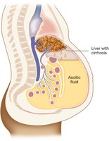 Ascites due to liver cirrhosis