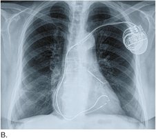 Pacemaker chest x-ray