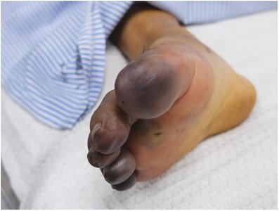 Necrosis of the toes