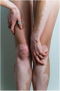 Vitiligo on the legs