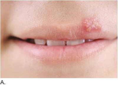 Herpes simplex type 1 vesicles on the lips