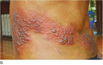 Shingles vesicles along a dermatome