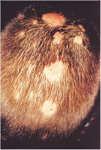 Tinea capitis (ringworm) on the scalp