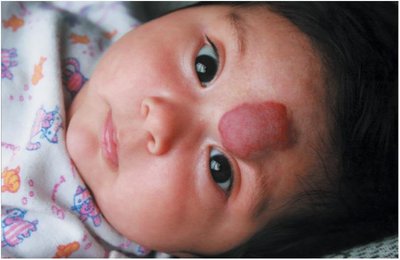 Hemangioma with bright red color