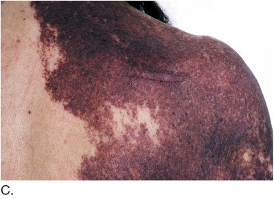Port-wine stain nevus