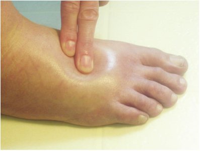 Pitting edema demonstrated by indentation on the foot