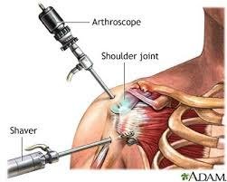 Arthroscope procedure