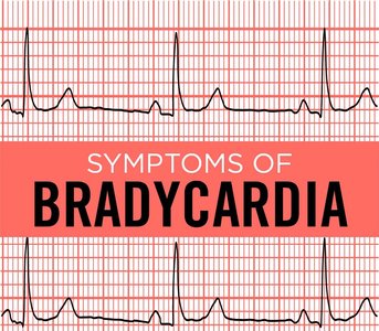 Bradycardia ECG