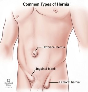 Common types of hernia