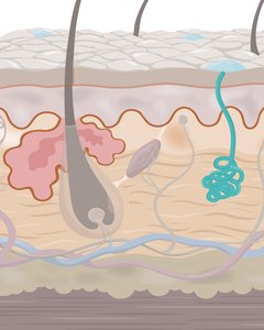 Sweat gland cartoon