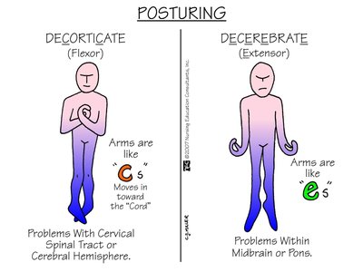 Posturing: Decorticate vs Decerebrate