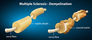 Multiple sclerosis demyelination