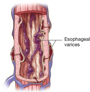 Esophageal varices