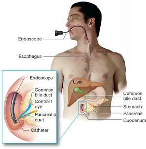 Endoscopic retrograde cholangiopancreatography (ERCP)