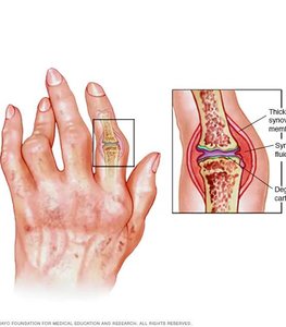 Hand with rheumatoid arthritis and inflamed joint