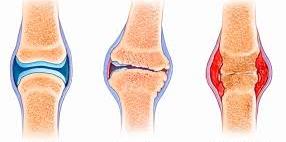 Progression of joint changes in arthritis