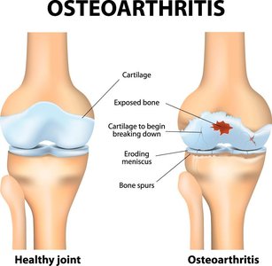 Diagram comparing healthy joint and osteoarthritis joint