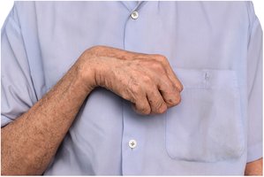 Muscle contracture