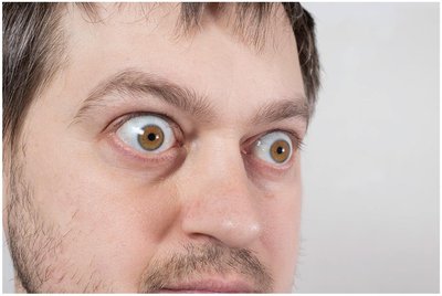 Exophthalmos in hyperthyroidism