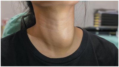Goiter: enlarged thyroid gland