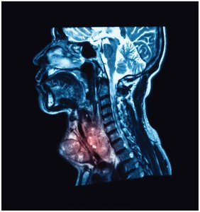 MRI of thyroid carcinoma