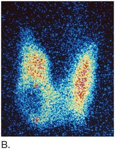 Radioactive iodine uptake scan of the thyroid