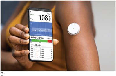 Continuous glucose monitoring device