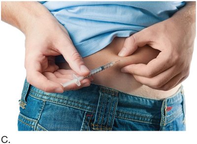 Insulin injection technique