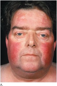 Cushing syndrome: moon face and red cheeks