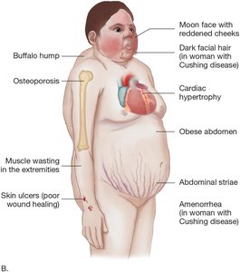 Cushing syndrome: body changes and muscle wasting