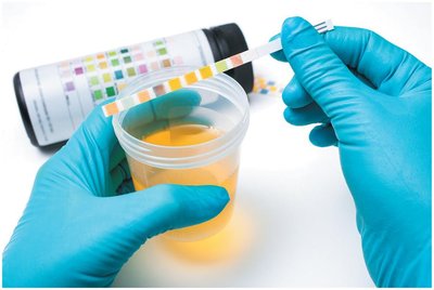 Urine dipstick test for glucose and ketones