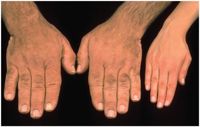 Acromegaly: enlarged hands