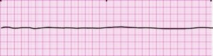 True asystole on EKG