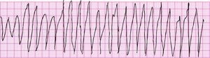 Toothbrush tachycardia artifact