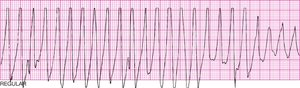 True ventricular tachycardia
