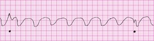 CPR artifact on EKG