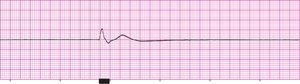 Rhythm without CPR artifact