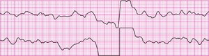 Defibrillation/cardioversion artifact