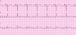 Artifact in three leads monitored simultaneously