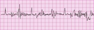 Somatic tremors artifact on EKG