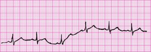Baseline sway artifact on EKG