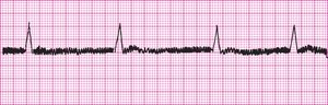 60-cycle interference artifact on EKG