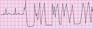Broken recording artifact on EKG
