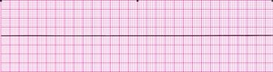 Artifact masquerading as asystole (flat line)