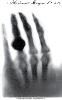 First X-ray image of a hand